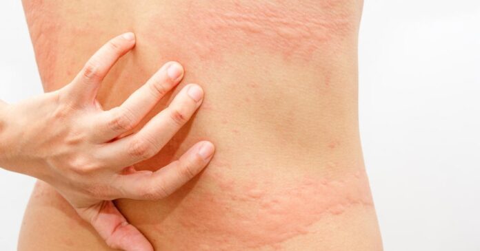 PERNAMBUCO: Pulga pode ter relação com lesões de pele que causam coceira; diz sanitarista