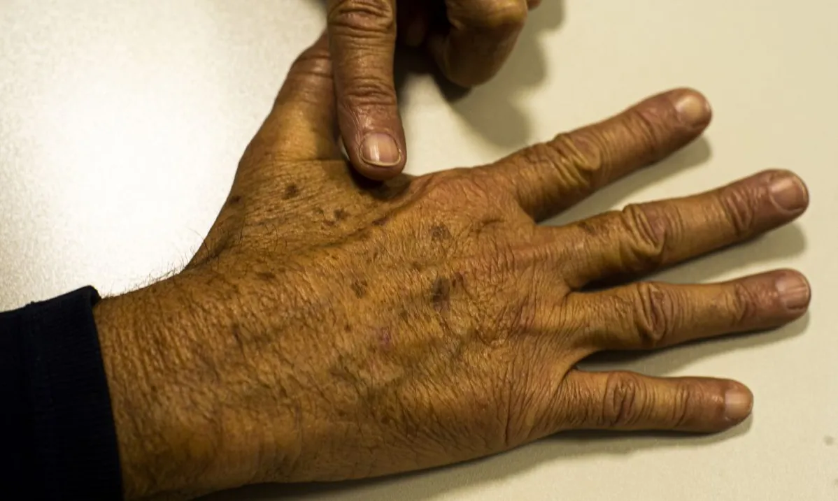 Tecnologia contra câncer de pele é aprovada para uso no SUS
