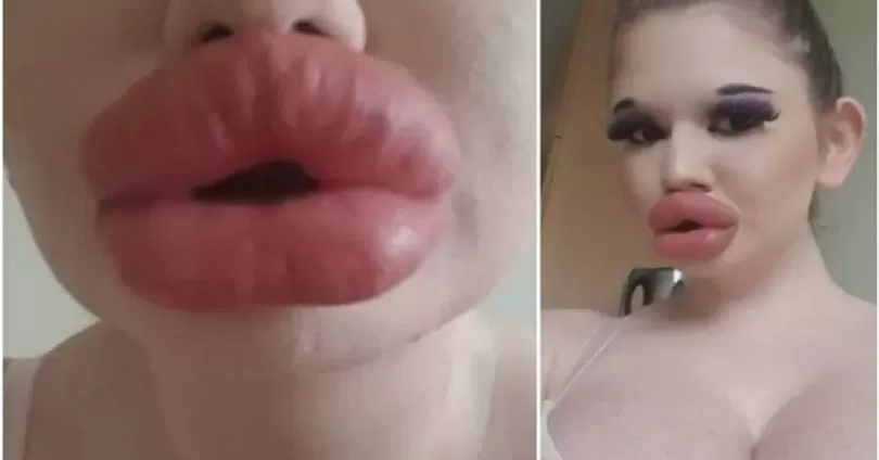 BIZARRO: Modelo com maiores lábios do mundo quer aumentar sua boca ainda mais