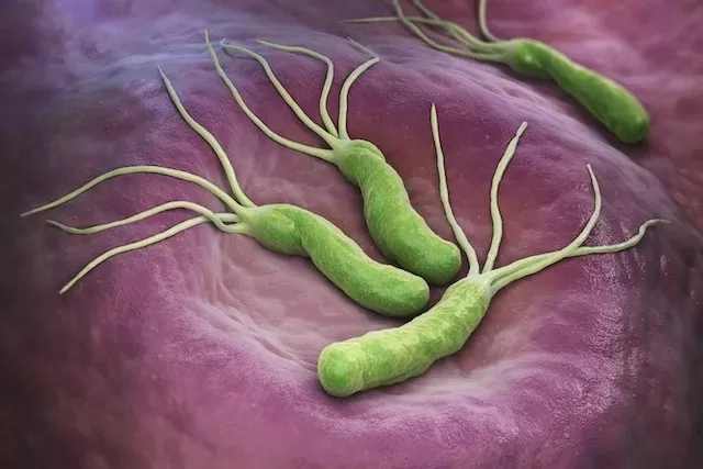 CONHEÇA O TRATAMENTO: Bactéria H. Pylori pode aumentar o risco para o desenvolvimento de úlceras e câncer