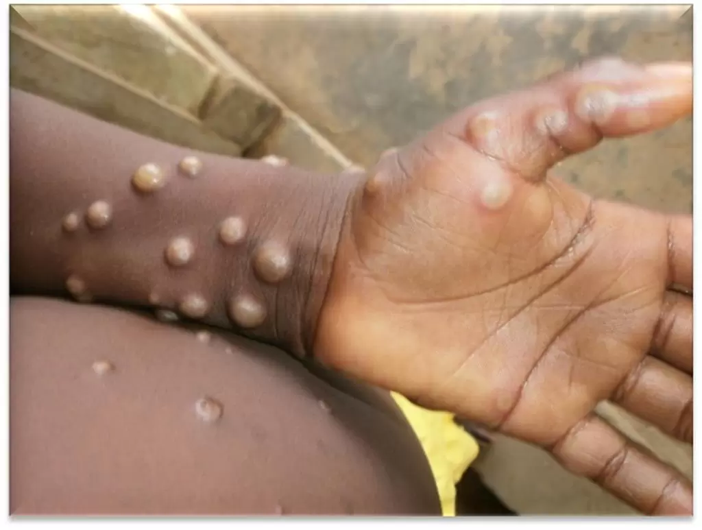 Varíola dos macacos: o que é a doença, seus sintomas e por que ela afeta humanos