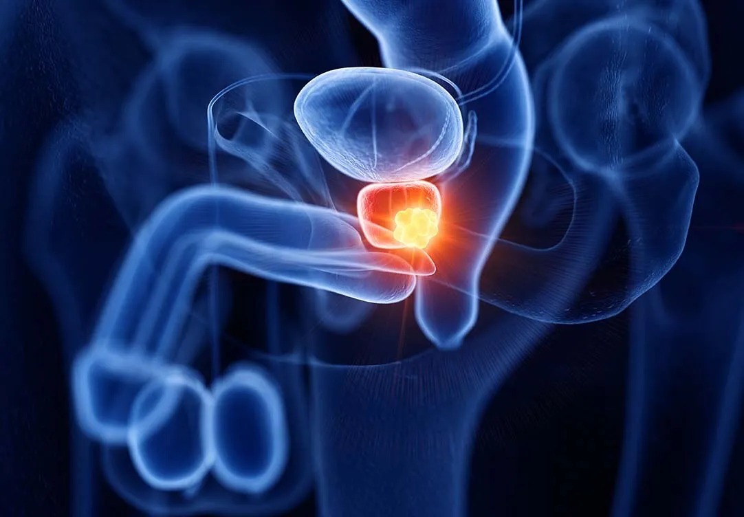 Câncer de Próstata: O que você precisa saber